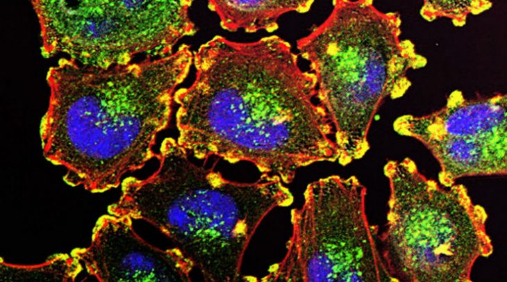Metastatic-Melanoma-Cells