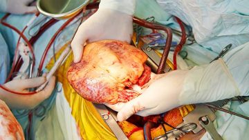heart surgery